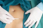 Chirurgie nach Gewichtsabnahme Chirurgie nach Gewichtsabnahme
