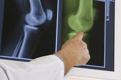 Patientenseminar - Die Knieprothese